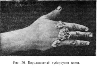 ������������ ���������� ����. Tuberculosis cutis verrucosa