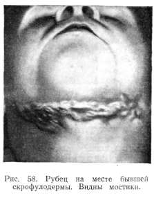 �������������, ������ �������� (SCROPHULODERMA, TUBERCULOSIS COLLIQUATIVA)