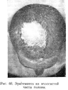 ����������, ������������� �������� (ERYTHEMATOSUS, LUPUS ERYTHEMATODES)