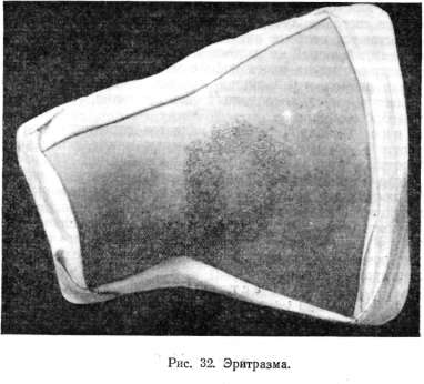 Erythrasma, ���������