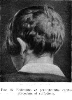 ����������� ���������� ������ (FOLLICULITIS ET PERIFOLLICULITIS CAPITIS ABSCEDENS ET SUFFODIENS)